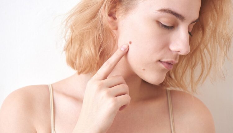 التخلص من الشامات