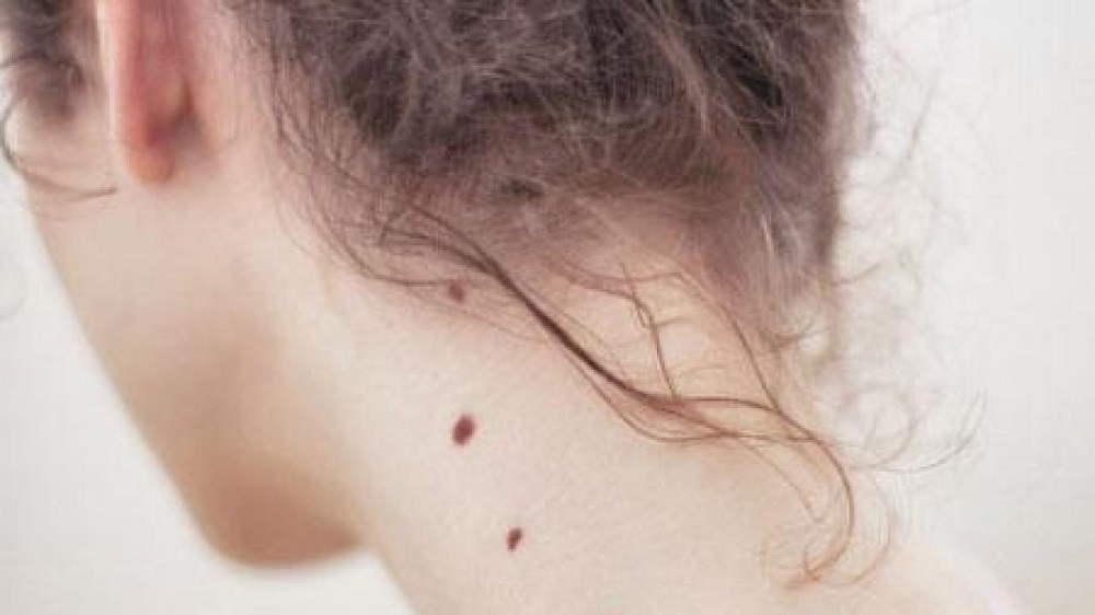 التخلص من الشامات