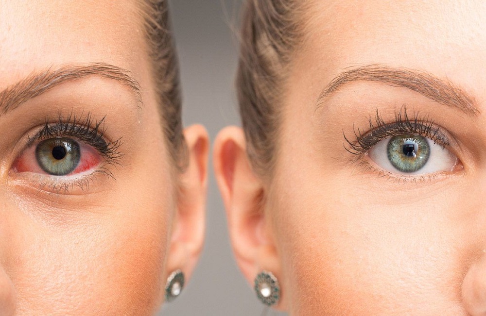 اسباب احمرار العين