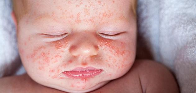 أعراض مرض الوردية عند الرضع