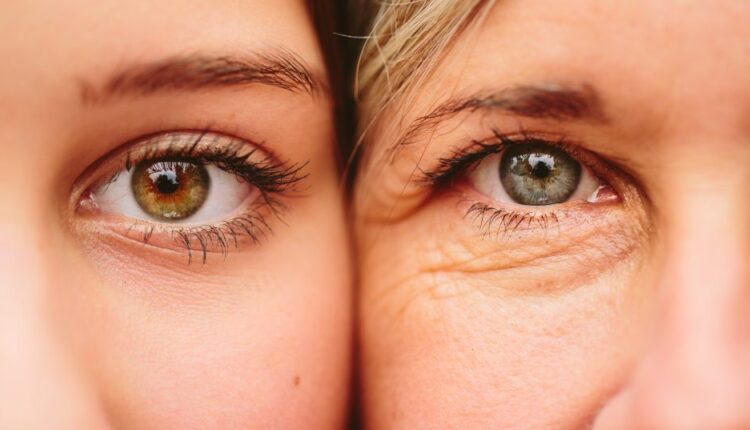 علاج الخطوط تحت العين