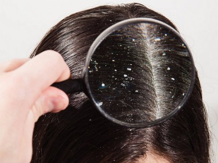 وصفات طبيعية للتخلص من قشرة الشعر نهائيا
