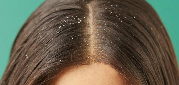 علاج فطريات الشعر