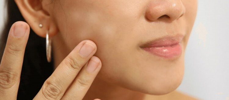 ما هو مرض النخالة البيضاء