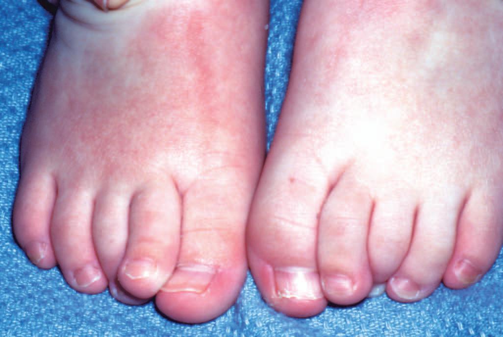 تشوهات أصابع القدم عند الأطفال
