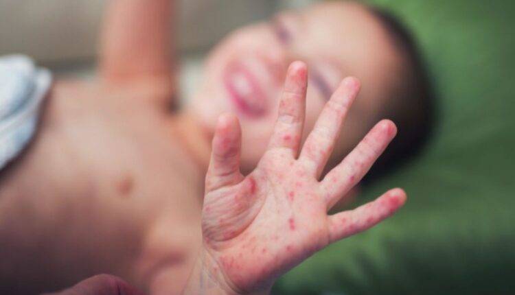 أسباب ظهور حبوب في اليدين والرجلين عند الأطفال