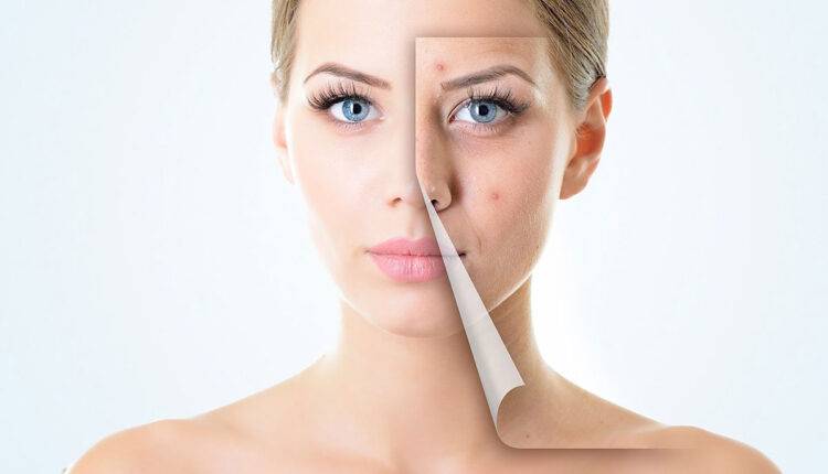 كيف أزيل آثار الحبوب من الوجه في يوم واحد