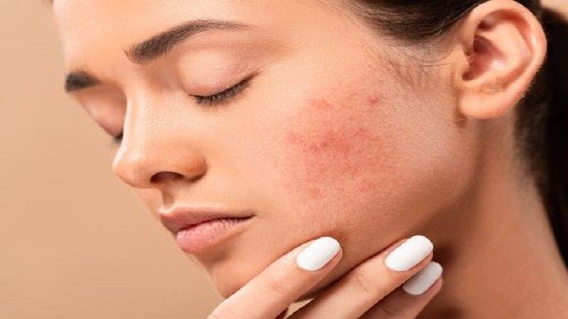 ماسك لازالة اثار الحبوب