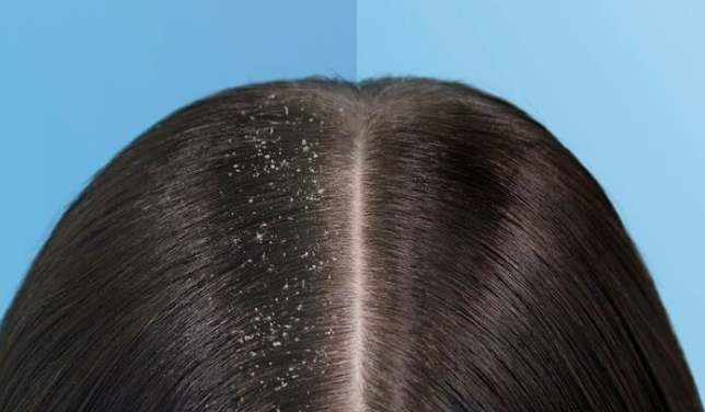 طرق علاجية طبيعية للتخلص من قشرة الشعر